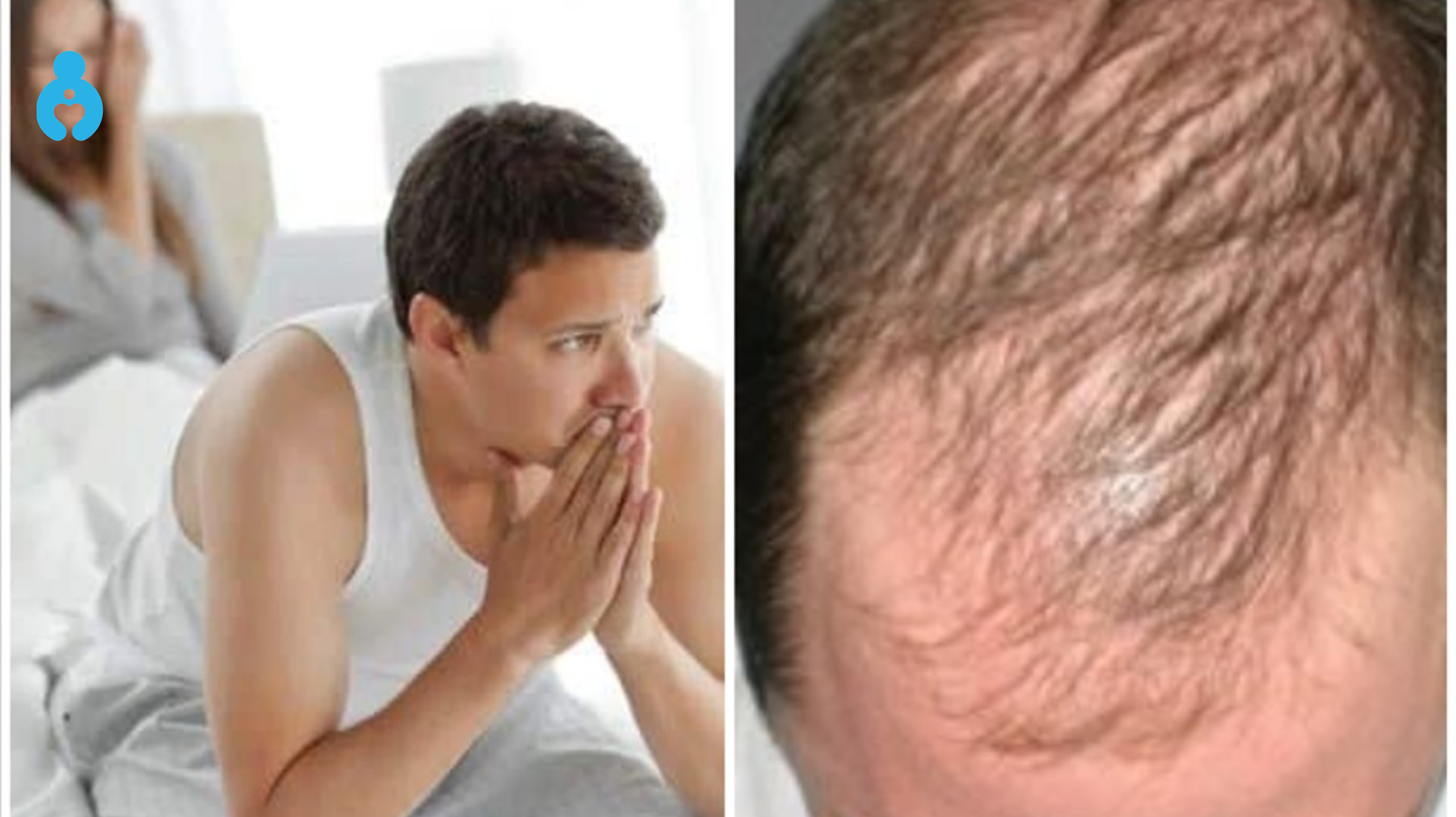 Dấu hiệu rụng tóc do testosterone thấp